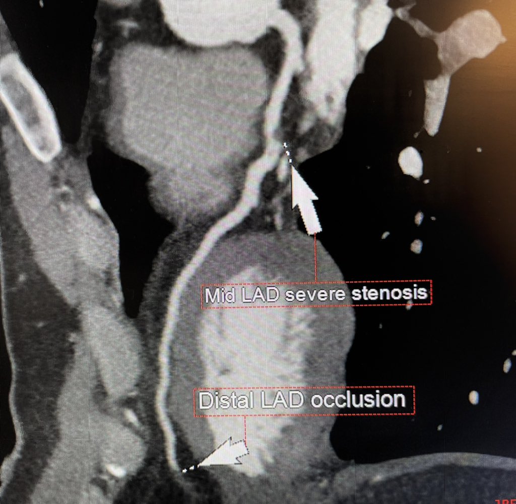 apdwi87's tweet photo. 33 year old presented with atypical chest pain found to have thromboembolic disease in LAD, from non calcified vulnerable plaque. #CCTAFirst. #CCTA https://t.co/NQx41MP1Qq