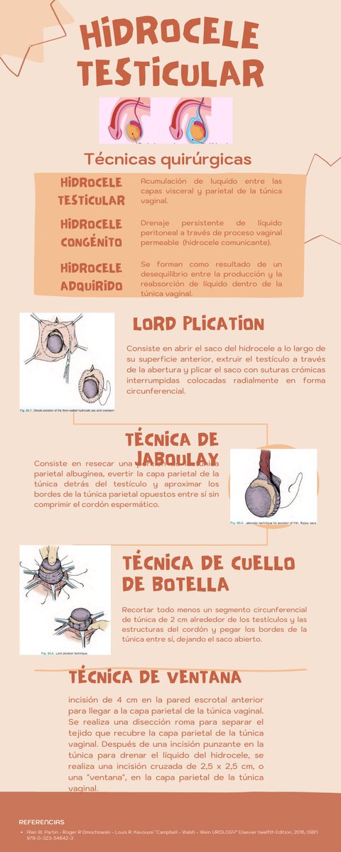 LuisCaz86625685's tweet photo. Hidrocele un padecimiento común en la práctica urológica diaria #UroHCM https://t.co/YnsViQdkny