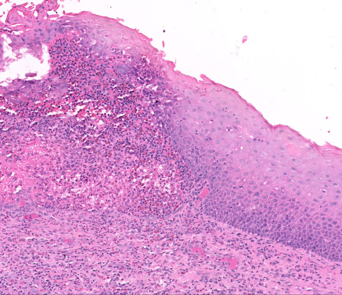 forthejon's tweet photo. This patient has ulcerative colitis. What is the best diagnosis? https://t.co/xWz9dODIrP From the Sid Barsky Collection. #dermpath #dermatology #pathology https://t.co/FiPuJdMlmE