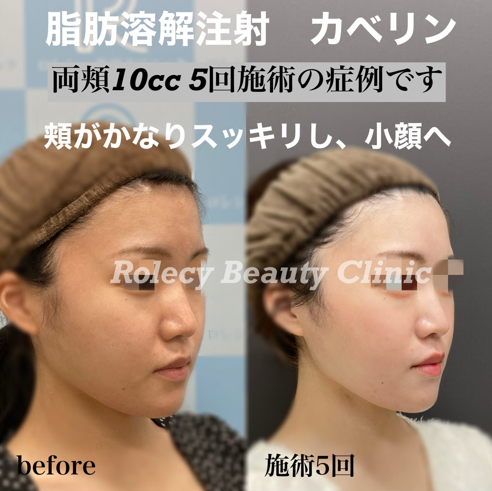 脂肪吸引顔 Twitter Search Twitter