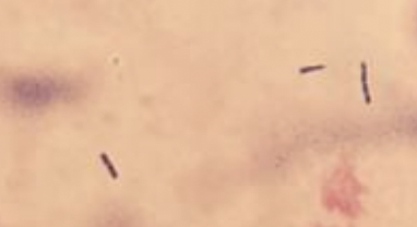 .@InfDiseasesNow Our lab has just published the 1st case of Filifactor alocis bacteremia associated with facial cellulitis in post-partum period. This report emphasizes the importance of dental care in pregnant women. To discover "who" is Filifactor 👉 sciencedirect.com/science/articl…