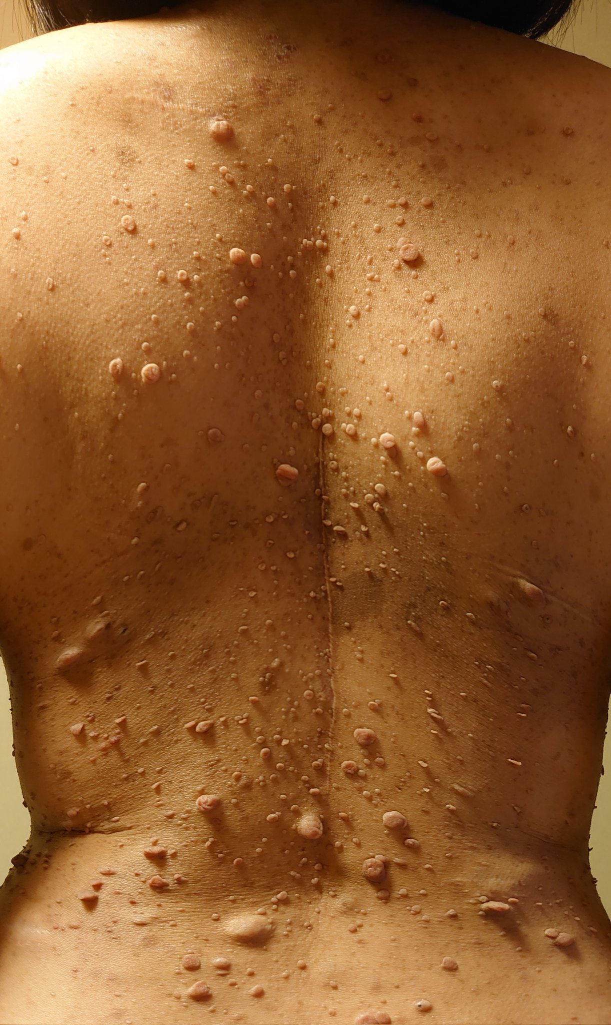 تويتر 大河内愛美 指定難病と向き合うガラス作家 على تويتر 指定難病 レックリングハウゼン病 出生時に3000人に1人が発症 人によって症状が様々 症状が軽いと生涯気付かない人も 6月に背部の神経線維腫 神経の上に出来る腫瘍 を取りました 尚 胸部はこれよりも多い