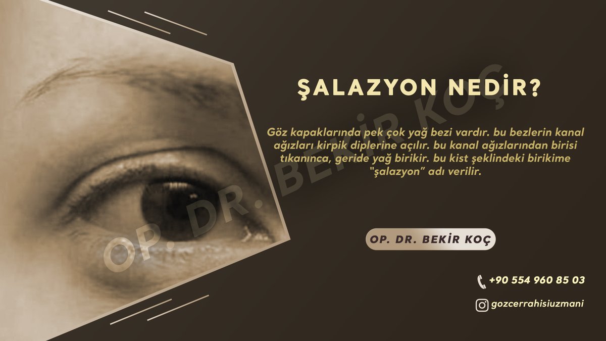 Göz kapaklarının kenarlarında bulunan bezlerin tıkanması sonucu göz kapağında oluşan kistler, şalazyon veya göz kapağı kisti olarak adlandırılır. 
Op. Dr. BEKİR KOÇ
+90 554 960 85 03
#opdrbekirkoç #malatya #malatyagözdoktoru #gözdoktoru #şalazyon