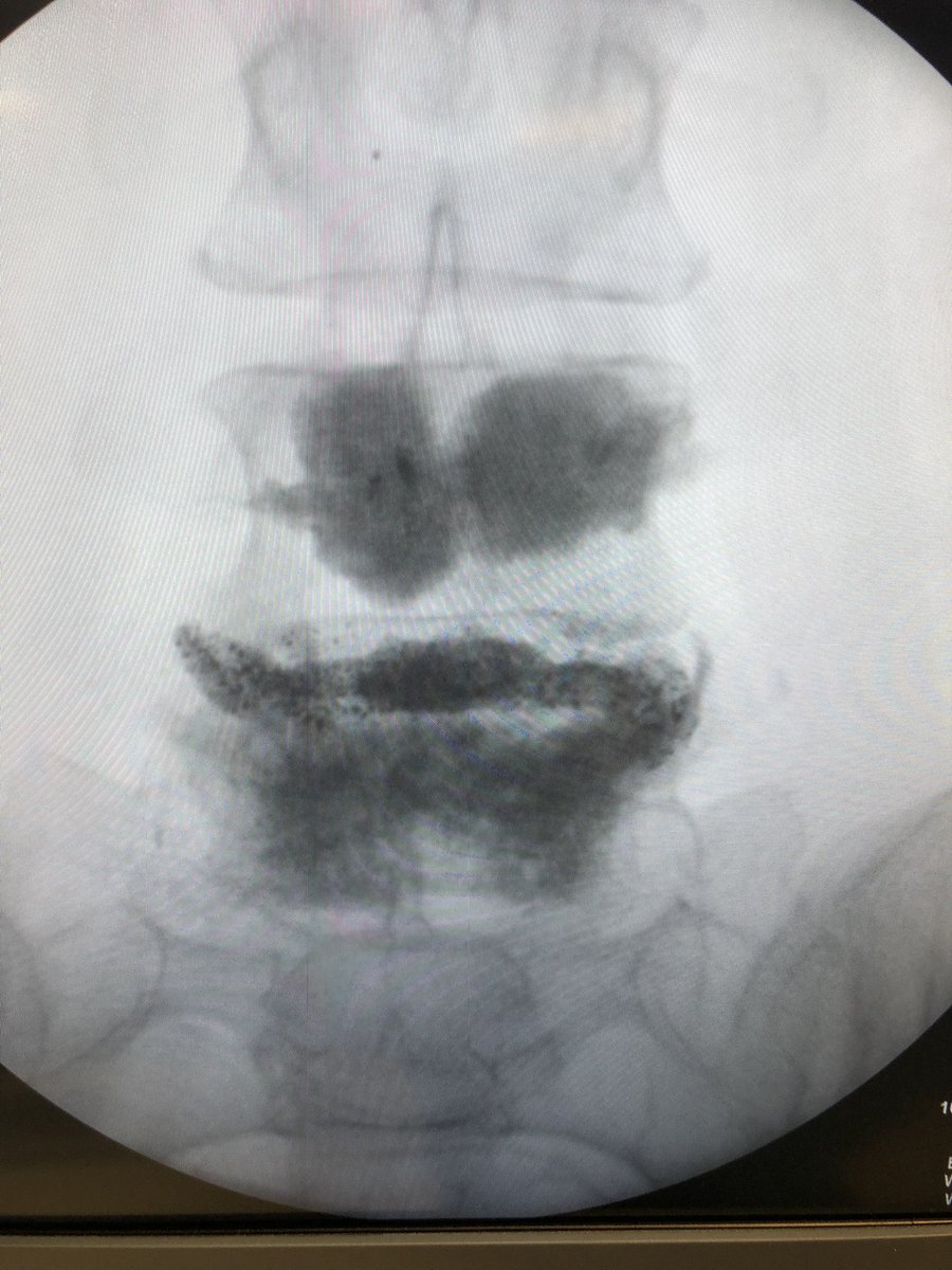 Elderly patient with #VCFs and spinal stenosis. Not a surgical candidate. #vertebralaugmentation and reduction of #spondylolishesis with titanium implant = fracture pain and stenosis symptoms gone. #discjack