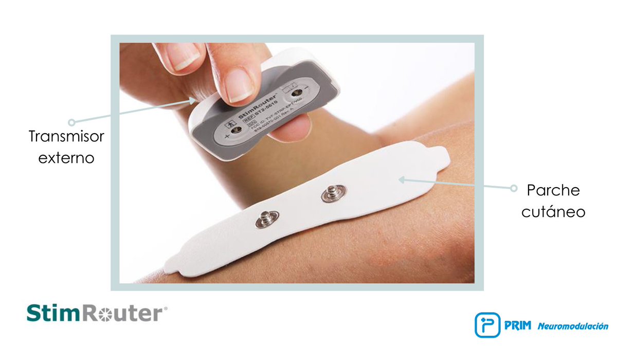 primneuromod's tweet photo. El dispositivo #StimRouter permite la estimulación de nervios periféricos con implantación mínimamente invasiva.
Su emisor de impulsos aporta #neuroestimulación desde el parche hasta el electrodo.
✅ Parche desechable
✅ Uso externo
✅ Batería recargable
#dolorneuropático https://t.co/po4aM7NwDL