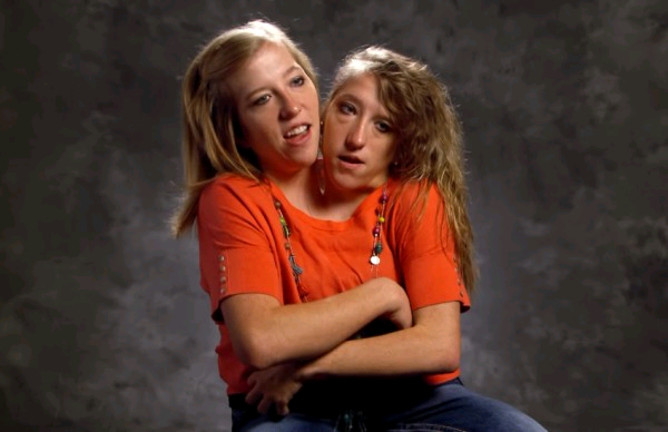 Knovhov TV on X: Abby and Brittany Hensel: Conjoined twins are very rare  in the world. Since they have two brains, they should be regarded as two  separate participants in examinations and