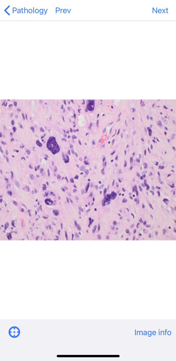 BoSTT_app's tweet photo. Have a look at Case 109 in the @BoSTT_app . Large soft tissue tumour #radiology #pathology #bstpath #mskrad #sarcoma #FOAMed #FOAMrad https://t.co/Qff0741RRo