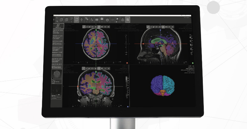 Pixel_Techn's tweet photo. Neuro AI supports the diagnosis of brain diseases. Segmentation of anatomical structures of brain based on MRI studies; demyelinating lesions to track disease progression +monitor treatment response. Atrophy assessment #ArtificialIntelligence in #neurology https://t.co/MRxuzKeRct