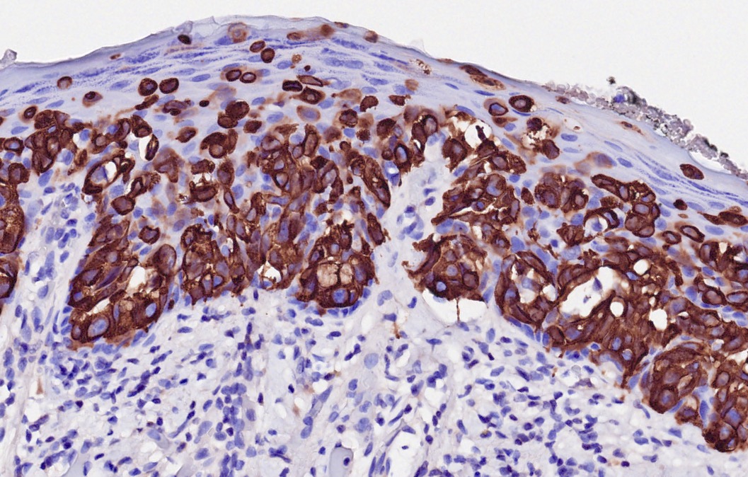 Primary vulvar extra-mammary Paget disease (CK7 shown). #pathboards #pathspotter (1/3)