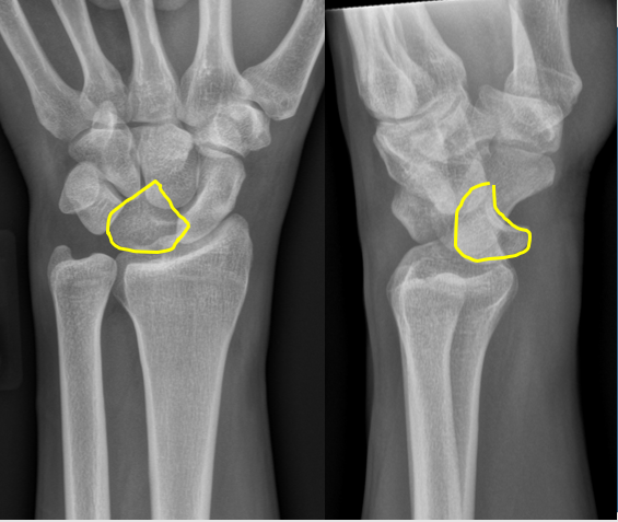 Lunate Dislocation Pie Sign