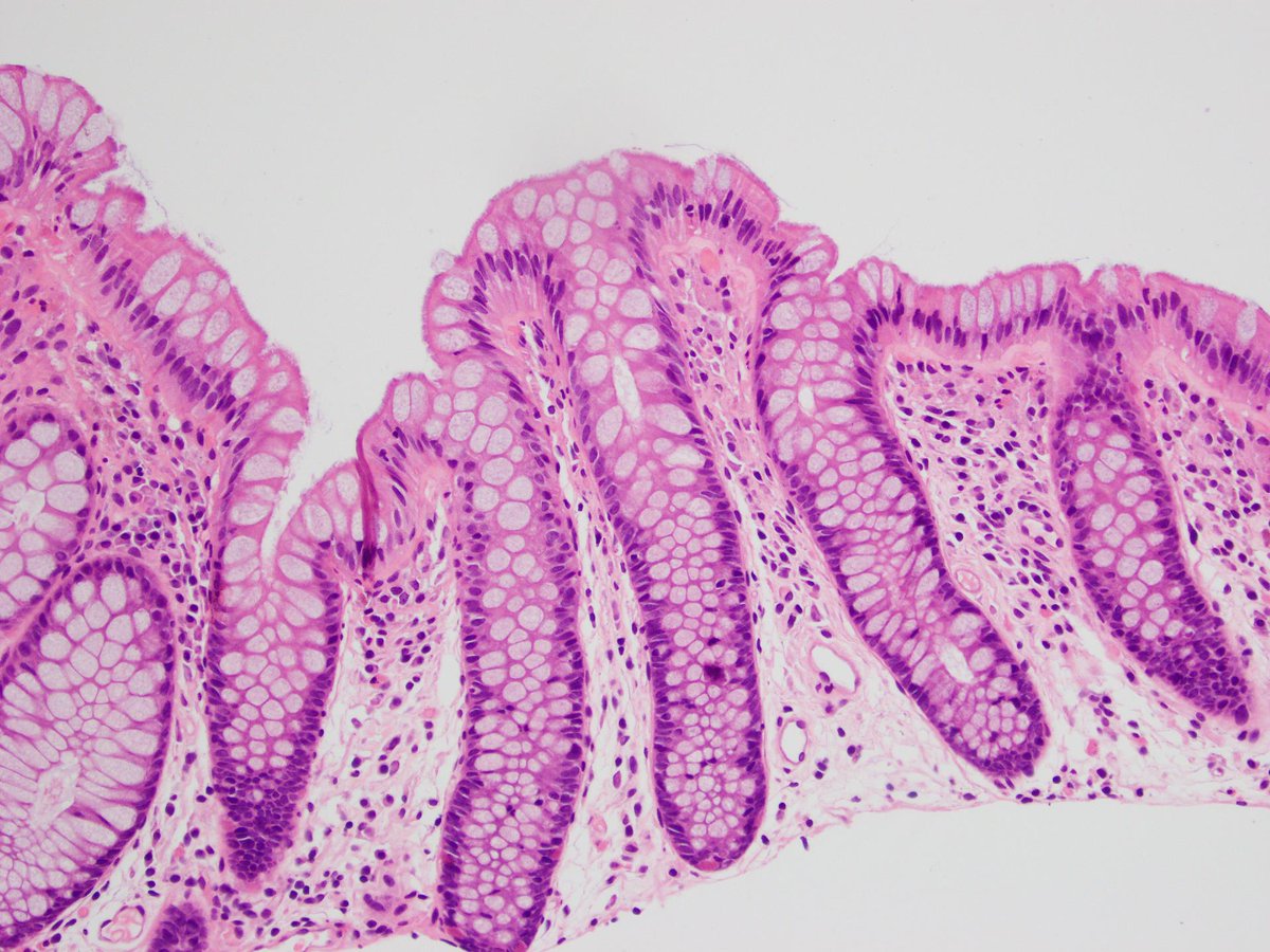 DrLaurenceGalea's tweet photo. Colonic spirochetosis

Images: Anaerobic intestinal spirochetes carpeting the epithelial surface.

•Incidental finding in majority of cases with no clinical correlates
•In some can be associated with abdo pain, diarrhoea, rectal bleeding

#PathTwitter, #PathResident, #GIPath https://t.co/ezzPCiEJ5L
