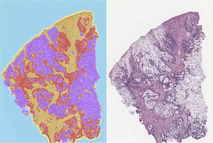 Merenlin's tweet photo. First article from the project I'm currently working on: https://t.co/9BoTkKX5yD Check it out! Can mucinous histology predict molecular sub-type of colorectal cancer? #modernpathology #cancer #bioinformatics #medicine https://t.co/I0tNQXC9dy