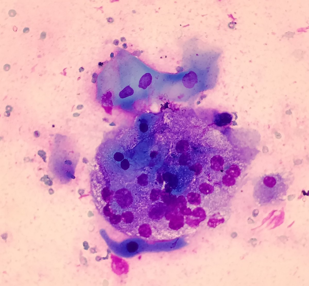 AnupamaArya12's tweet photo. 66/M FNAC-Submandibular lesion.#cytology #pathtwitter #submandibular https://t.co/OryYo0gYNf