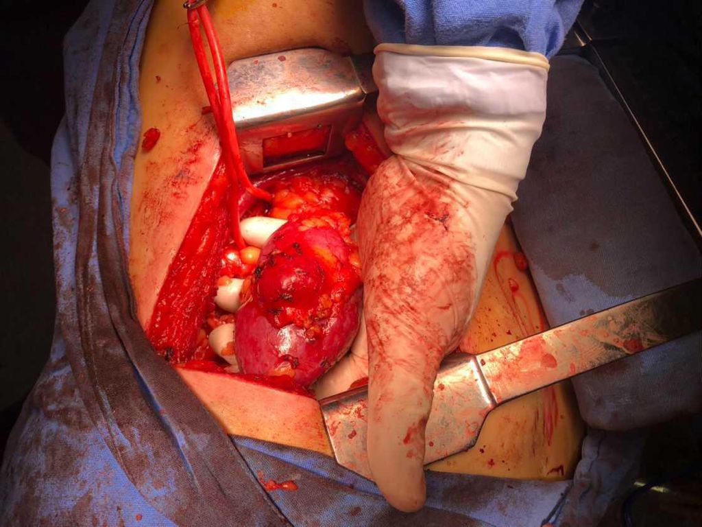 umaemac's tweet photo. Cirugía preservadora de nefronas izquierda en femenino de 65 años con cáncer de riñón izquierdo T1a N0 M0 EC I #Urology #Oncolgy https://t.co/YeC1yXGgWP