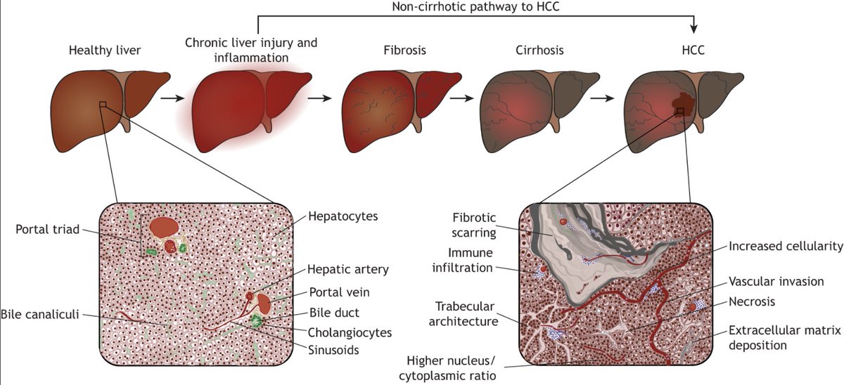 Dev_journal's tweet photo. Signalling pathways and transcriptional regulators orchestrating liver development and cancer

In their Review, @stephi_campbell, @HoodlessLab and colleagues discuss liver development, cancer and the use of hepatic tissue engineering models 

https://t.co/Kr2j8LJ2Q6 https://t.co/oByUjh4sFZ