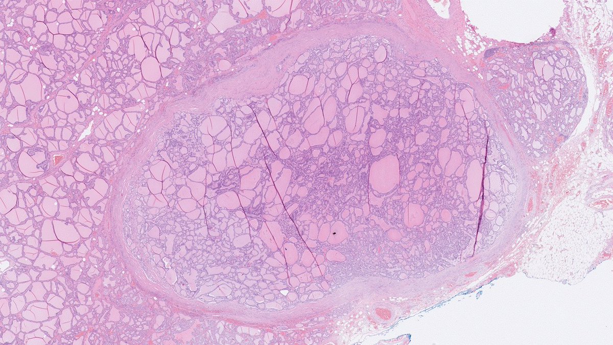 34-year-old female patient with Graves' disease. No prior FNAC. Planned for thyroidectomy, but surgery was limited to the left lobe due to loss of nerve signals. 6 mm nodule evident during grossing. Encapsulated and well demarcated, macro- to microfollicular pattern: