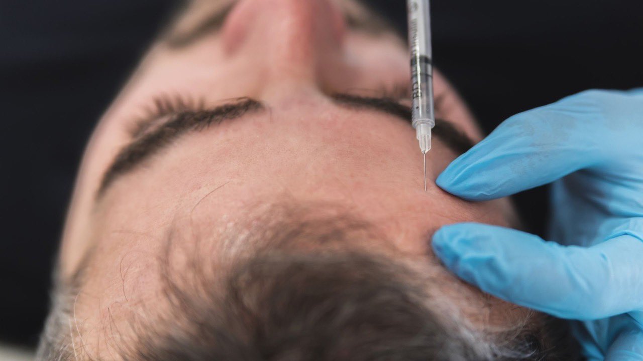 Glossy Magazine в Twitter: „Dermal filler for men; we look at the top things to consider if you're a fella considering filler. /tmInIoUUsY 🙎🏻♂️💉 #filler #fillerformen #dermalfiller #malefiller #aesthetics #beauty ... Glossy Magazine в Twitter: „Dermal filler for men; we look at the top things to consider if you're a fella considering filler. /tmInIoUUsY 🙎🏻♂️💉 #filler #fillerformen #dermalfiller #malefiller #aesthetics #beauty ...