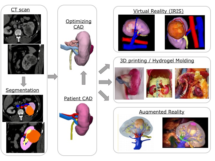Ahmed Ghazi (@aghazimd) on Twitter photo Join me & a panel of experts <a href="/jdhdavis/">John W. Davis, MD</a> <a href="/PorpigliaF/">Porpiglia Francesco</a> <a href="/MABjurlin/">Marc A. Bjurlin</a> & Dr. Link <a href="/AmerUrological/">Amer. Urol. Assn.</a> 2021 Virtual meeting #AUA21 presenting latest innovations in Patient-Specific Simulation for partial nephrectomy including #3Dprinting #VirtualReality #AugmentedReality -FRI Sept10th 9am PT Join me & a panel of experts <a href="/jdhdavis/">John W. Davis, MD</a> <a href="/PorpigliaF/">Porpiglia Francesco</a> <a href="/MABjurlin/">Marc A. Bjurlin</a> & Dr. Link <a href="/AmerUrological/">Amer. Urol. Assn.</a> 2021 Virtual meeting #AUA21 presenting latest innovations in Patient-Specific Simulation for partial nephrectomy including #3Dprinting #VirtualReality #AugmentedReality -FRI Sept10th 9am PT