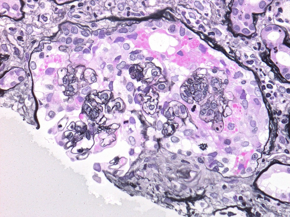 Seen in a case of IgAN. Do you think this represents collapsing glomerulopathy or a cellular crescent? How many mitotic figures do you see?