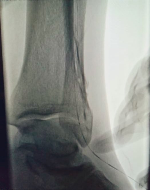 Paulo Menezes Filho (@paulomenezesf) on Twitter photo Retrograde access saves limbs! Even in hopeless cases! #CLIfighters <a href="/Leocortizo1/">Leonardo Cortizo, MD</a> <a href="/andrebrq/">André Brito Queiroz</a> <a href="/motarodrigos/">Rodrigo Mota</a> <a href="/jmills1955/">Joseph L. Mills MD</a> <a href="/limbsalvagedr/">Leigh Ann O'Banion</a> <a href="/CLIfighters/">CLIfighters</a> @ Retrograde access saves limbs! Even in hopeless cases! #CLIfighters <a href="/Leocortizo1/">Leonardo Cortizo, MD</a> <a href="/andrebrq/">André Brito Queiroz</a> <a href="/motarodrigos/">Rodrigo Mota</a> <a href="/jmills1955/">Joseph L. Mills MD</a> <a href="/limbsalvagedr/">Leigh Ann O'Banion</a> <a href="/CLIfighters/">CLIfighters</a> @