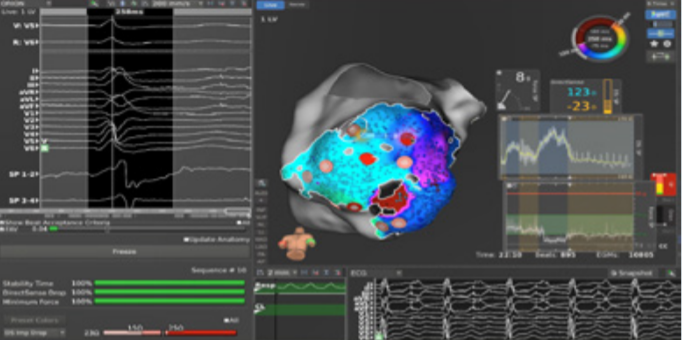 BSC_EU_Heart's tweet photo. In this technical note, Dr Solimene confirms #STABLEPOINT featuring #DIRECTSENSE local impedance is useful for assessing procedural safety, catheter contact and lesion formation in #VT.
Check out his findings here: https://t.co/DETrxsptvD
#EPeeps https://t.co/kPianQRPBN