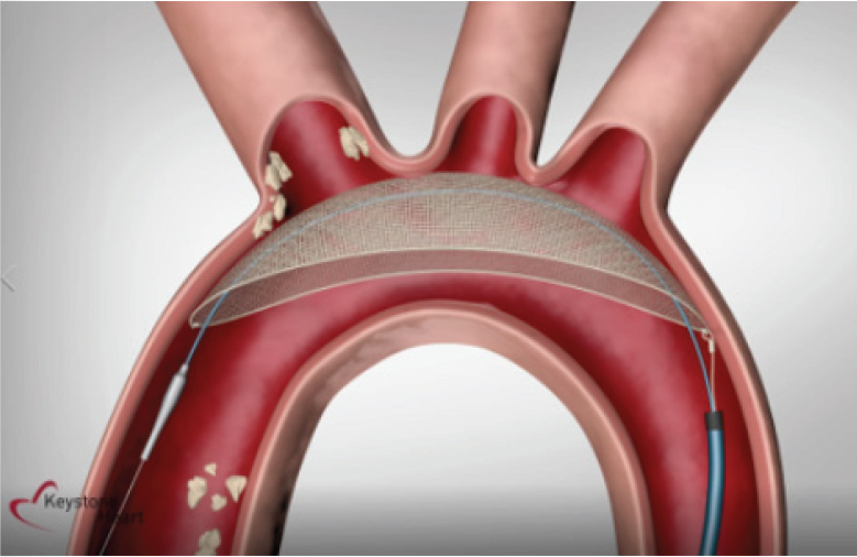 Vessel_Plus's tweet image. #ProtectionDevices #TAVI Good article sharing &quot;Routine use of cerebral protection devices during transcatheter aortic valve implantation: what does the evidence say?&quot;
@ozkr_millan @rafasadaba @ernestocardio @FabriziougoMD @GreggWStone 
Download free👇
vpjournal.net/article/downlo…