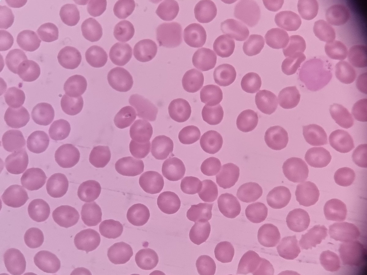 msreddy1011's tweet photo. Patient has no symptoms. Came for routine checkup where we found platelet count around 48,000 and smear showed target cells . LFT,LIPID,USG ABDOMEN - NORMAL. @Swathiprabhu5 @vi_monappa https://t.co/sOcx94rw3G