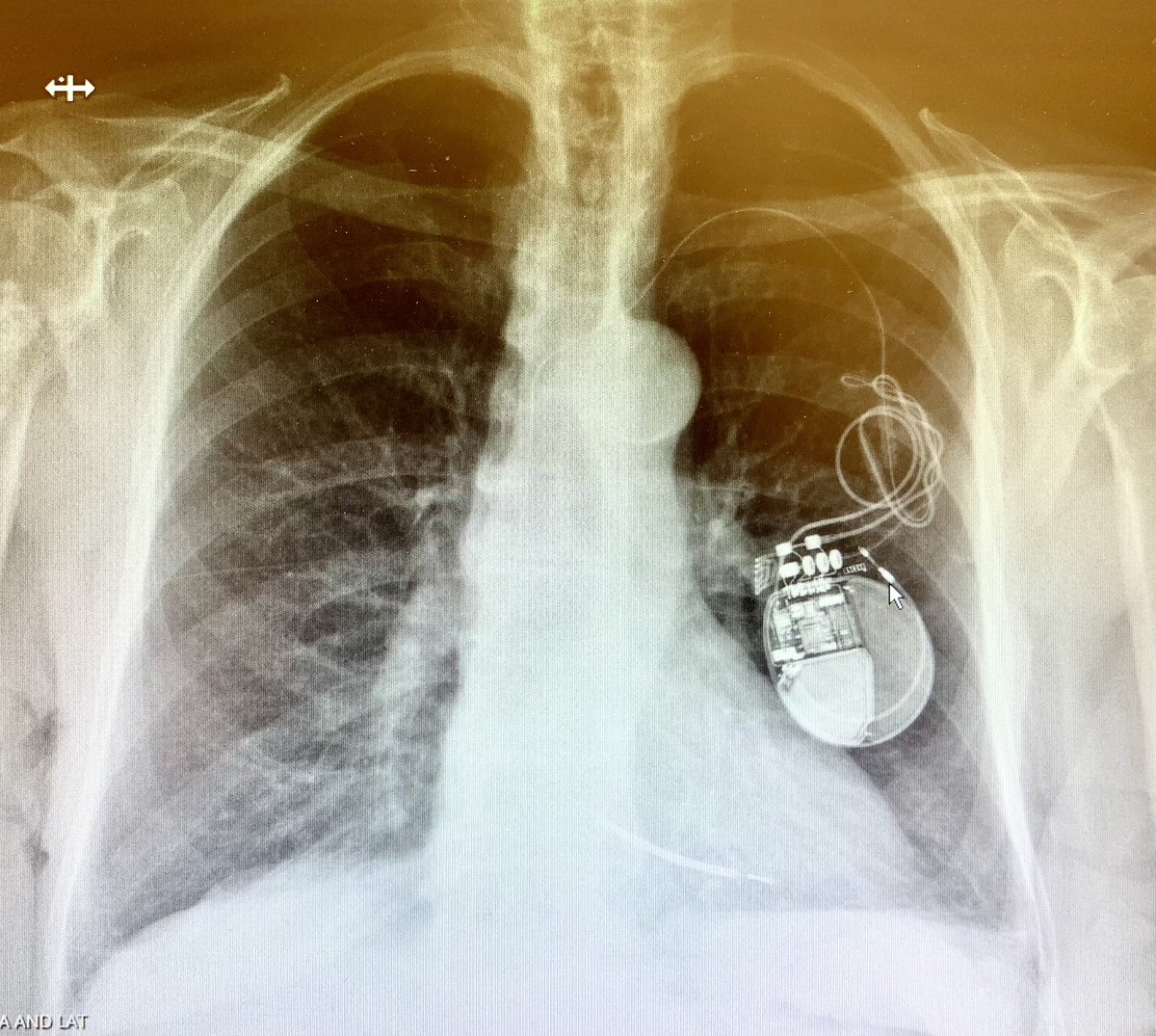 LeadInLeadOut's tweet photo. #EPpeeps this can’t be just device movement and lead retraction right? Twiddler? #askmedtwitter #devices https://t.co/fGdc0jxOEZ