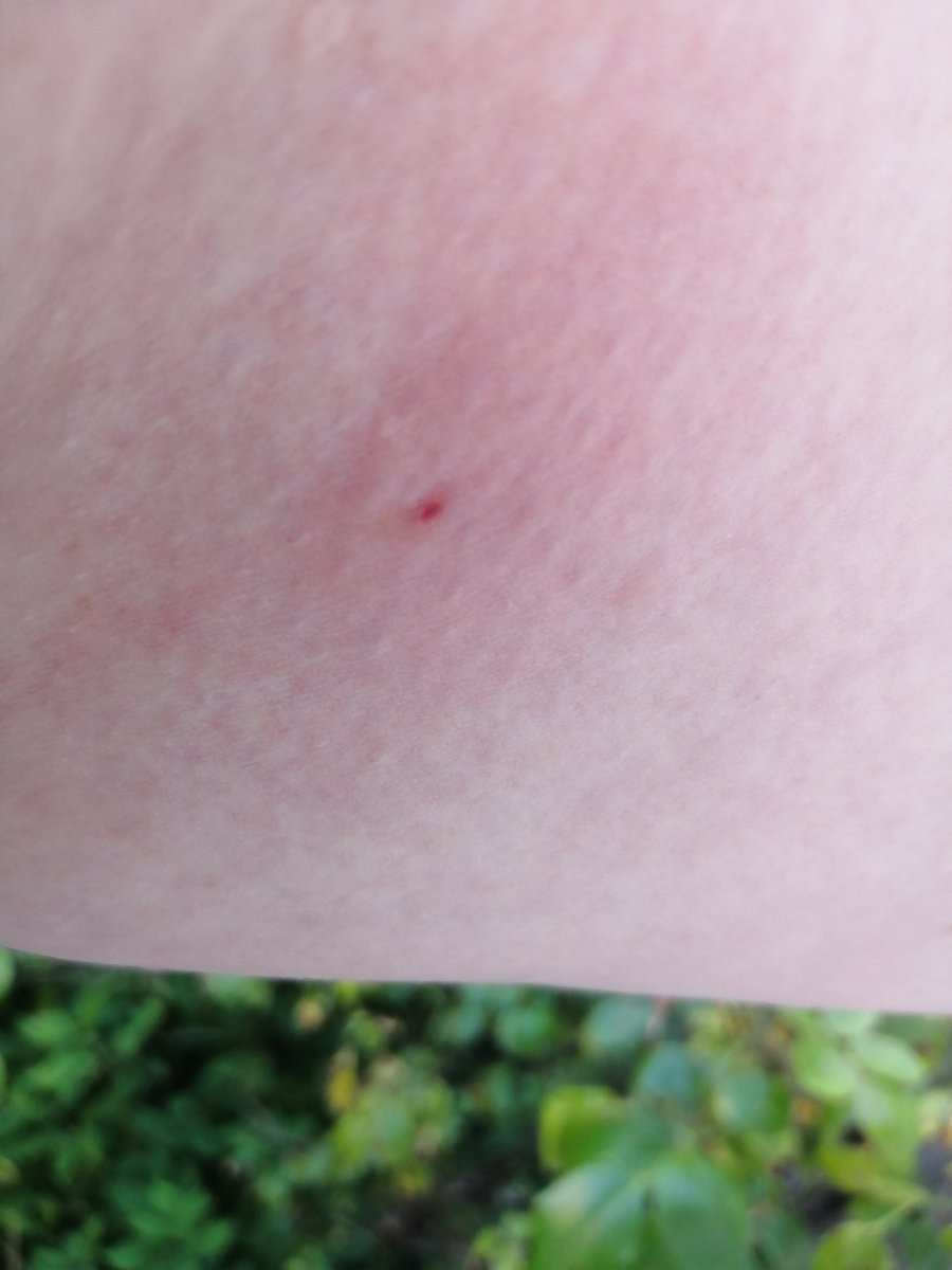 jtwolfenden's tweet image. Just now while chatting to @hypsipyle on Framwellgate Bridge, a bee went into my armpit and then came out and stung my upper inner arm. This is my first bee sting since 1998 when I got bit on my backside using an outdoor toilet in Rome while @the_bsr #importantnews
#ouch #owee