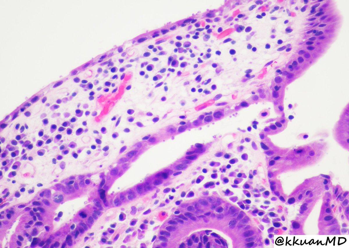 Kevin Kuan (@kkuanmd) on Twitter photo Small intestinal biopsy from a 30yo M with abdominal pain and chronic diarrhea. #pathtwitter #pathology #infectious #pathboards #Microbiology #residenteducation
<a href="/EinsteinPath/">Einstein Montefiore Pathology</a> <a href="/yokoda_md/">Raquel Yokoda, MD</a> <a href="/ALBoothMD/">Adam L. Booth, MD</a> <a href="/Dr_Brian_Cox/">Brian Cox, MD, MAS</a> <a href="/Gagandeepk5MD/">Gagandeep Kaur</a> <a href="/ParasiteGal/">Bobbi Pritt, MD</a> <a href="/c_castrodad/">Carlos Castrodad-Rodríguez, MD</a> <a href="/RSekhri_MD/">Radhika Sekhri</a> <a href="/Rebecca_MMR/">Rebecca M. Marrero Rolon</a> Small intestinal biopsy from a 30yo M with abdominal pain and chronic diarrhea. #pathtwitter #pathology #infectious #pathboards #Microbiology #residenteducation
<a href="/EinsteinPath/">Einstein Montefiore Pathology</a> <a href="/yokoda_md/">Raquel Yokoda, MD</a> <a href="/ALBoothMD/">Adam L. Booth, MD</a> <a href="/Dr_Brian_Cox/">Brian Cox, MD, MAS</a> <a href="/Gagandeepk5MD/">Gagandeep Kaur</a> <a href="/ParasiteGal/">Bobbi Pritt, MD</a> <a href="/c_castrodad/">Carlos Castrodad-Rodríguez, MD</a> <a href="/RSekhri_MD/">Radhika Sekhri</a> <a href="/Rebecca_MMR/">Rebecca M. Marrero Rolon</a>