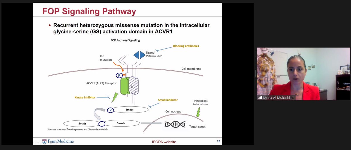 Endo Grand Rounds: Dr #MonaAlMukaddam from <a href="/PennMedicine/">Penn Medicine</a> presented on #FOP Fibrodysplasia ossificans progressiva - rare #bone disease w heterotopic bone formation. Autosomal dominant w ACVR1 pathogenic variants. Clin dx: malformed great toe &amp; tumor like swellings on the body.