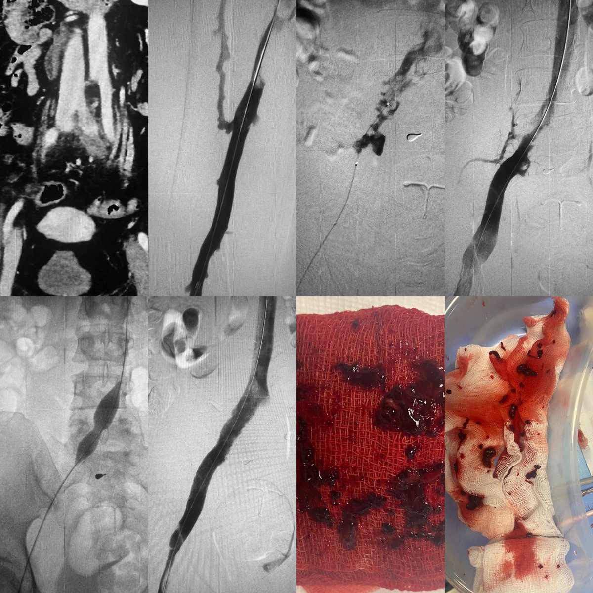 Acute lower limb thrombosis from an underlying May-Thurner syndrome. Single session Inari ClotTriever, IVUS and stenting - great outcome!