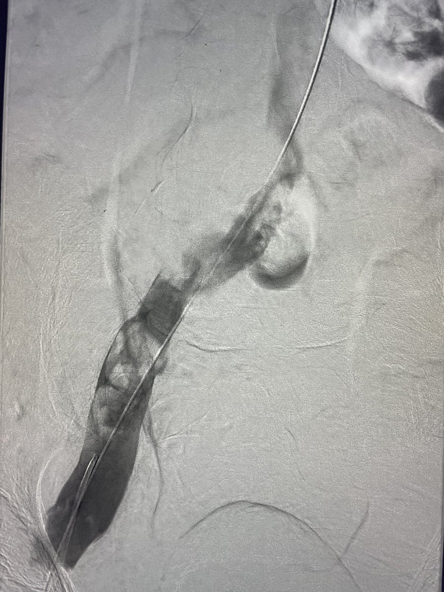 Iliofemoral DVT from today.  Multiple passes with an Inari ClotTriever with repeat angiogram after 8th pass.  Next step? #DVT @InariMedical