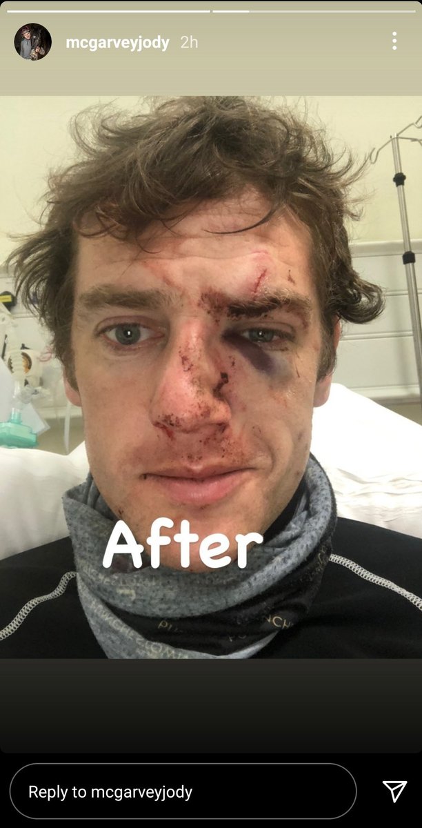 ⚠️ Graphic content 

Jump jockeys are a different breed 

Jody McGarvey battered and bruised after being unseated at Killarney this evening.

Probably won't keep him out of action for long though. Hopefully a quick recovery 🤞💪

(pictures from Jody's Instagram)