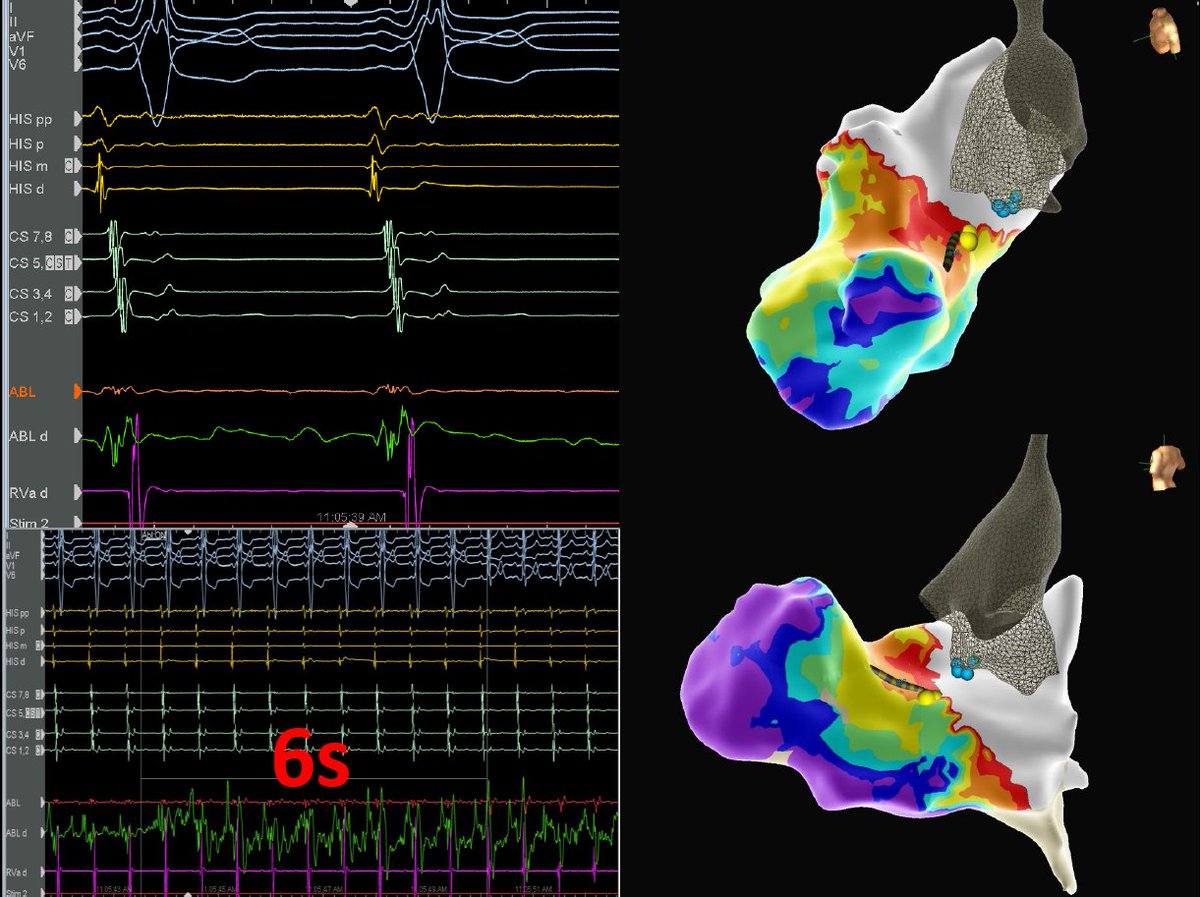 Ochsner Electrophysiology (@ochsnerep) on Twitter photo Successful ablation of antegrade only peri-his AP in 34 yoM with cardiomyopathy from NCC by <a href="/DanielPMorin/">Daniel P. Morin</a> <a href="/OchsnerCardio/">John Ochsner Heart & Vascular Institute</a>. Open-window mapping with #HDgrid revealed proximity of AP to His. Ablation at the continuous A-AP-V electrogram in NCC blocked AP in 6s. #EPeeps #EPfellows Successful ablation of antegrade only peri-his AP in 34 yoM with cardiomyopathy from NCC by <a href="/DanielPMorin/">Daniel P. Morin</a> <a href="/OchsnerCardio/">John Ochsner Heart & Vascular Institute</a>. Open-window mapping with #HDgrid revealed proximity of AP to His. Ablation at the continuous A-AP-V electrogram in NCC blocked AP in 6s. #EPeeps #EPfellows