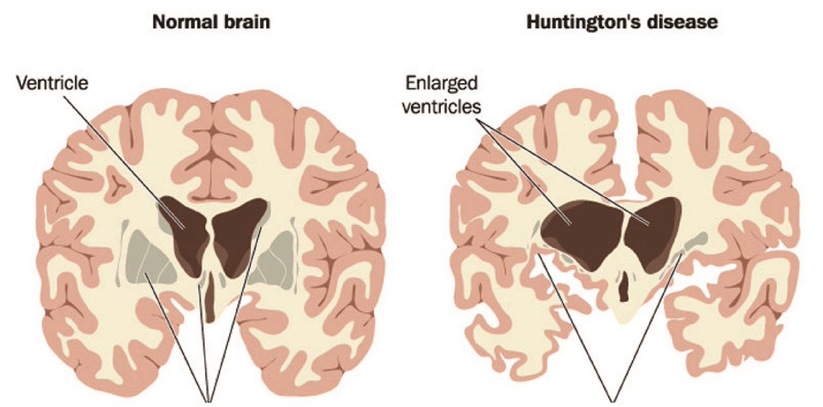 Tras las primeras sospechas, y habiendo descartado otras patologías, los análisis confirmaron que el hombre padecía la una grave enfermedad neurológica, la enfermedad de Huntington (EH)