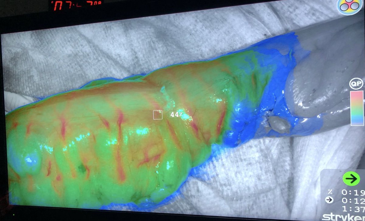 smoralesconde's tweet photo. Starting our experience with quantification of fluorescence with ICG to evaluate bowel perfusion in colorectal surgery...exciting to see how different colors show the best area for the anastomosis @EAES_eu @scmi_itec @aecirujanos @asacirujanos  @coloproctoaec @AECP_FAECP https://t.co/4zfAQVZRgf