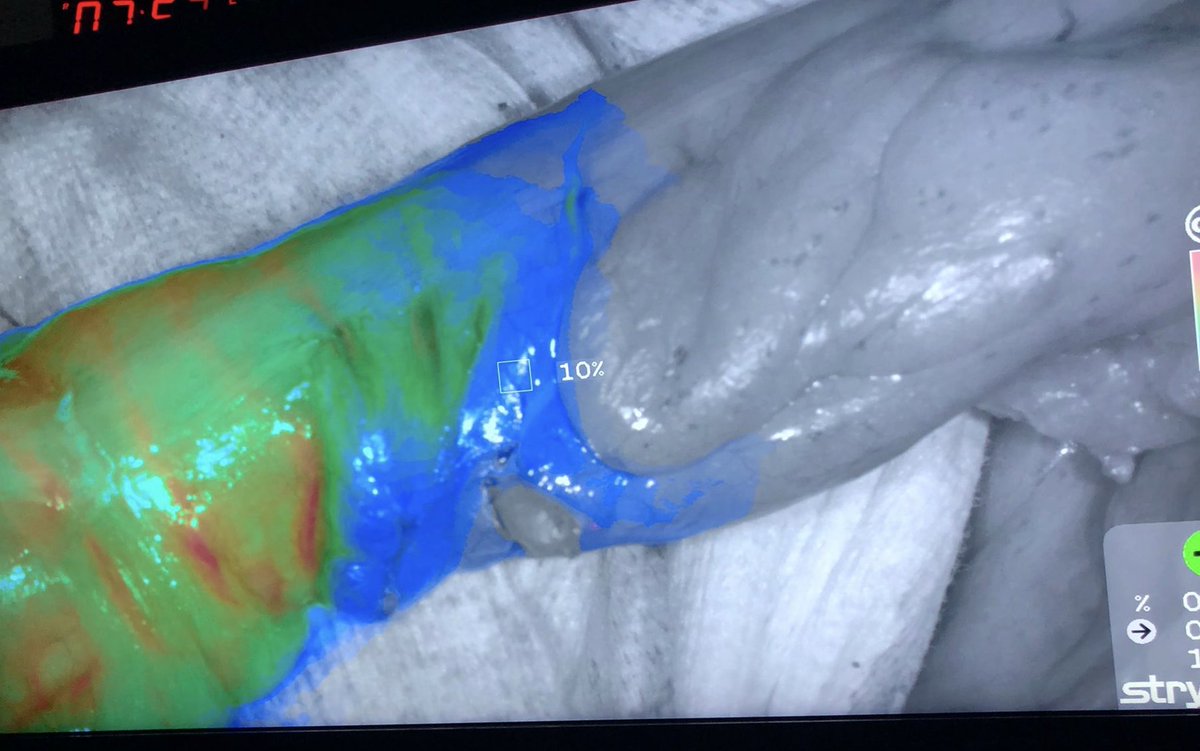 smoralesconde's tweet photo. Starting our experience with quantification of fluorescence with ICG to evaluate bowel perfusion in colorectal surgery...exciting to see how different colors show the best area for the anastomosis @EAES_eu @scmi_itec @aecirujanos @asacirujanos  @coloproctoaec @AECP_FAECP https://t.co/4zfAQVZRgf