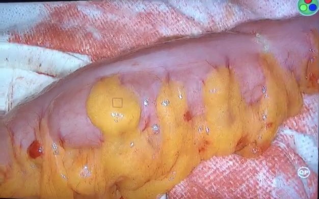 smoralesconde's tweet photo. Starting our experience with quantification of fluorescence with ICG to evaluate bowel perfusion in colorectal surgery...exciting to see how different colors show the best area for the anastomosis @EAES_eu @scmi_itec @aecirujanos @asacirujanos  @coloproctoaec @AECP_FAECP https://t.co/4zfAQVZRgf