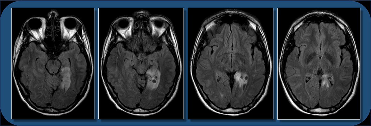 Hey  #radres and  #MEDstudents - a  #neurorad case for you today. 18yoF w/ seizure. What do you see? What is the ddx? And WHERE is the lesion? Case explanation and gyral  #neuroanatomy explanation coming soon.  #meded  #medtwitter  #FOAMed  #FOAMrad  #radiology  #neurology  #neurosurgery