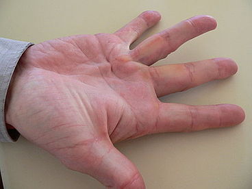 La enfermedad de Dupuytren o fibromatosis palmar es una patología frecuente. A veces limita la extensión de los dedos.
A pesar de que el tratamiento percutáneo ecoguiado es más eficiente que cualquier alternativa, apenas se usa.
Lo describiré a continuación. abro hilo