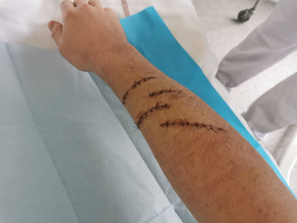 Voici une photos de mon bras au landemain de mon opération.Et une autre de mon bras aujourd'hui plus de 4 mois après mon opération marqué a vie.12/13