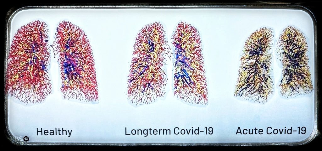 "Sembuh" bagi orang dengan Covid-19, bukan hanya hasil tes Swab-PCR negatif tapi bebas gejala sisa yg terus menghantuinya. COVID-19 bisa berlanjut, kerusakan organ juga terjadi. Jangan anggap remeh infeksi SarsCov2, banyak yg masih belum diketahui. Cegah agar tidak kena dg 3M.