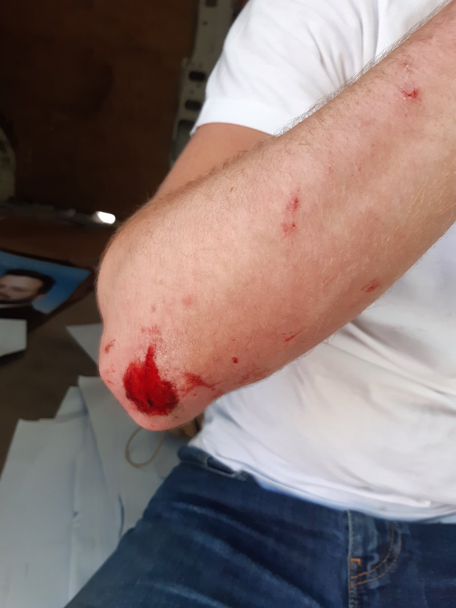 Enzo_Alias's tweet photo. Un de nos militants vient de se faire lâchement agresser pour un groupe de racaille dans le quartier de #Barriole à #Arles 😡 https://t.co/VQcSgyn3Rc https://t.co/lWmv0IO6BJ