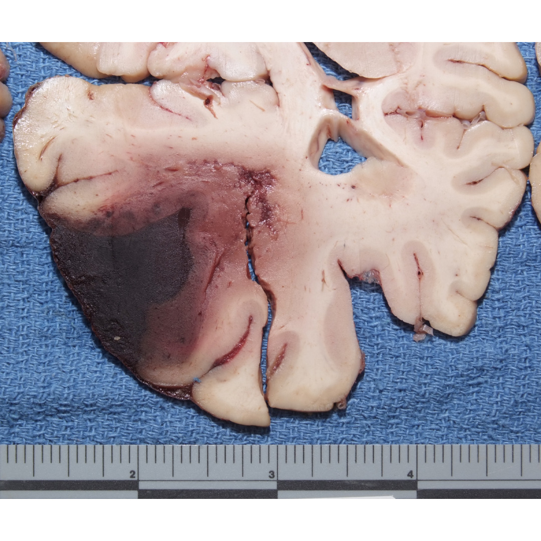 Ernesto Medio C. on X: ☠vasoconstrictorus extremis☠ esnifador habitual de # cocaína. necrosis de paladar con comunicación rinopalatina..  #JuntoSomosMásForenses 😎 ✌  / X