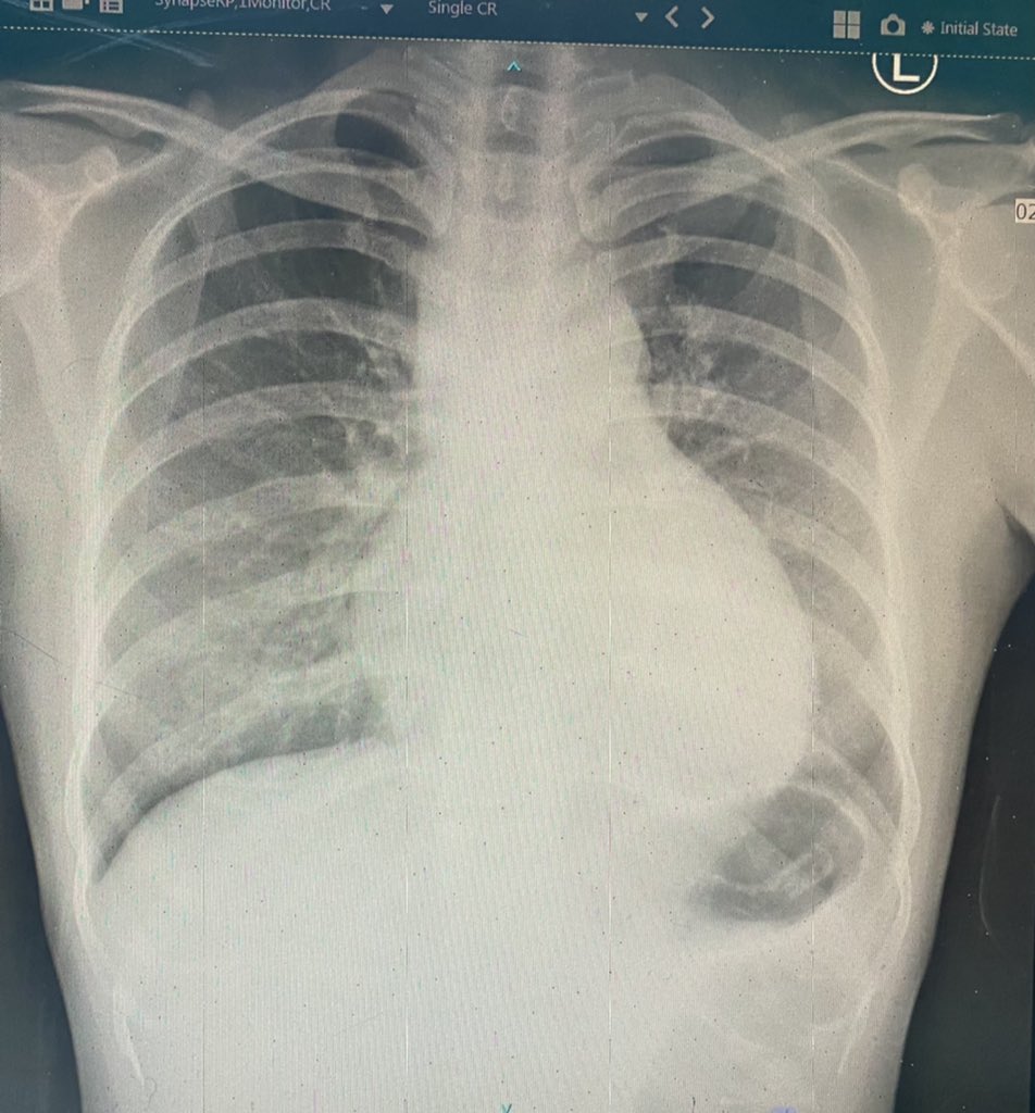 This patient was covid positive in Feb this year and only had cough as her symptom. Her chest xray shown here. Treated, quarantined and was on surveillance with 2 weekly swab. All the while negative. Then, she came back to hospital...
