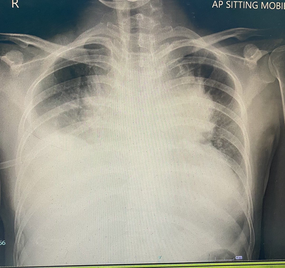 with complaint of shortness of breath and cough. This is her chest xray taken on day of admission. See those whites as compared to the previous one? Yeah, that means bad. Her condition worsened in the ward and she had to be intubated.