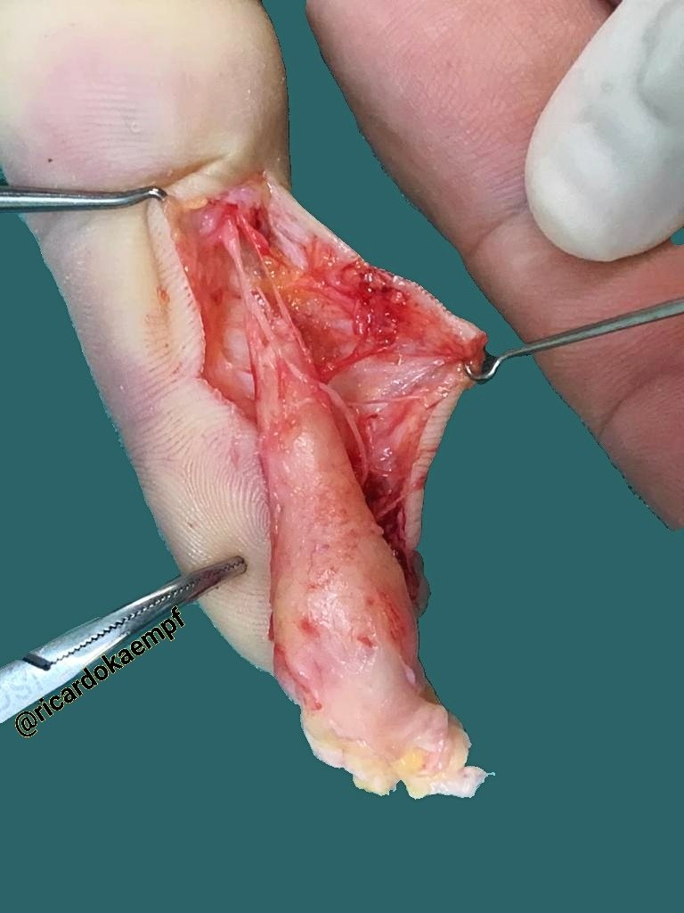 pbaleixo's tweet photo. Lipomatosis of nerve (neural fibrolipoma)》epineurium fibroadipose tissue expansion between nerve fibers》endoneurial hypertrophic change (can mimick intraneural perineurioma) #bstpath @SolerDoc @ScottBikeethan @Patholwalker @JMGardnerMD @histiocytosisX @UFCSPA_patho https://t.co/Em7n9j4j7a