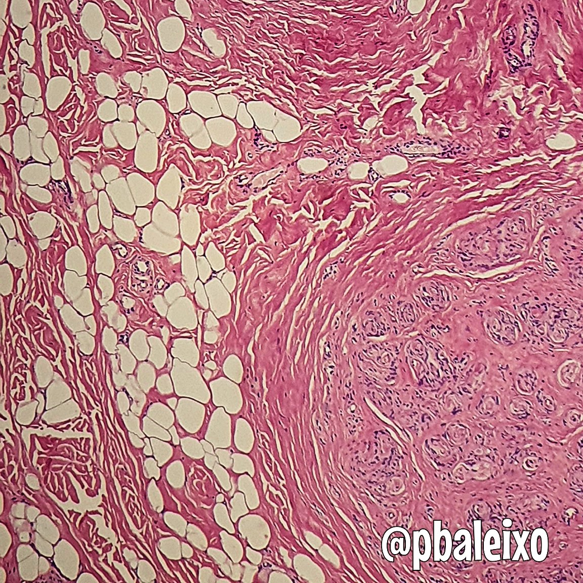 pbaleixo's tweet photo. Lipomatosis of nerve (neural fibrolipoma)》epineurium fibroadipose tissue expansion between nerve fibers》endoneurial hypertrophic change (can mimick intraneural perineurioma) #bstpath @SolerDoc @ScottBikeethan @Patholwalker @JMGardnerMD @histiocytosisX @UFCSPA_patho https://t.co/Em7n9j4j7a