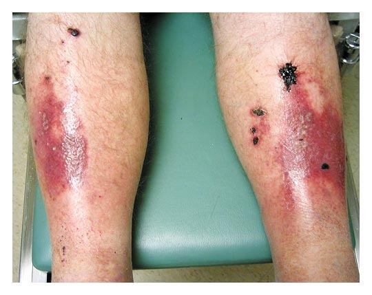 - A 52-year-old man with diabetes reported a 3-month history of a pretibial rash during a routine visit.
- The lesions had begun to ulcerate and bleed but were not pruritic or painful.

What is the diagnosis?

➡️ Full Case and Answer : manualofmedicine.com/spot-diagnosis…

#foamed #medtwitter